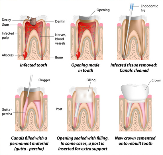 ROOT-CANAL-THERAPY